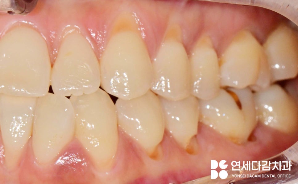 이시림 원인 치경부 마모증 치료할 때 쓰이는 문정역 치과 레진과 G.I 재료의 특성 관련 이미지 5