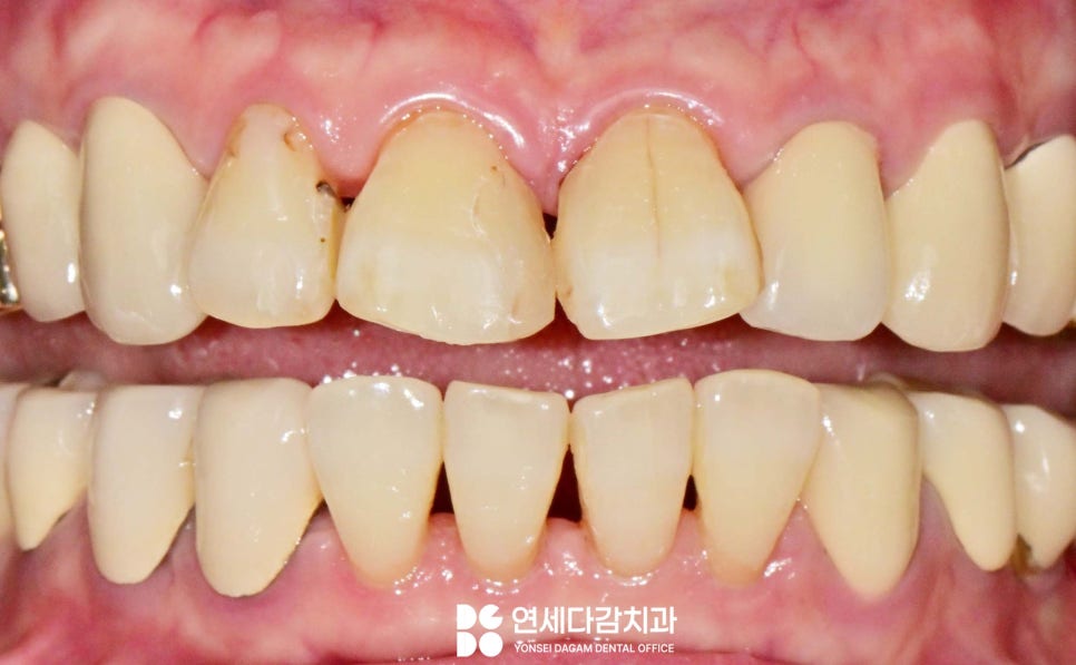 앞니 레진 후 생긴 변색 문제와 삐뚤어진 치아 개롱역 치과 최소삭제 라미네이트 적용할 수 있는 이유 관련 이미지 4