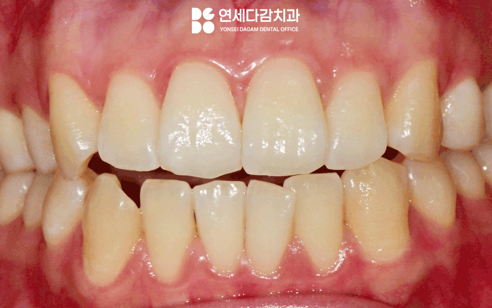 거여동 치과 전문가 치아 미백 원리와 올바른 관리 방법 알아봅시다. 관련 이미지 6