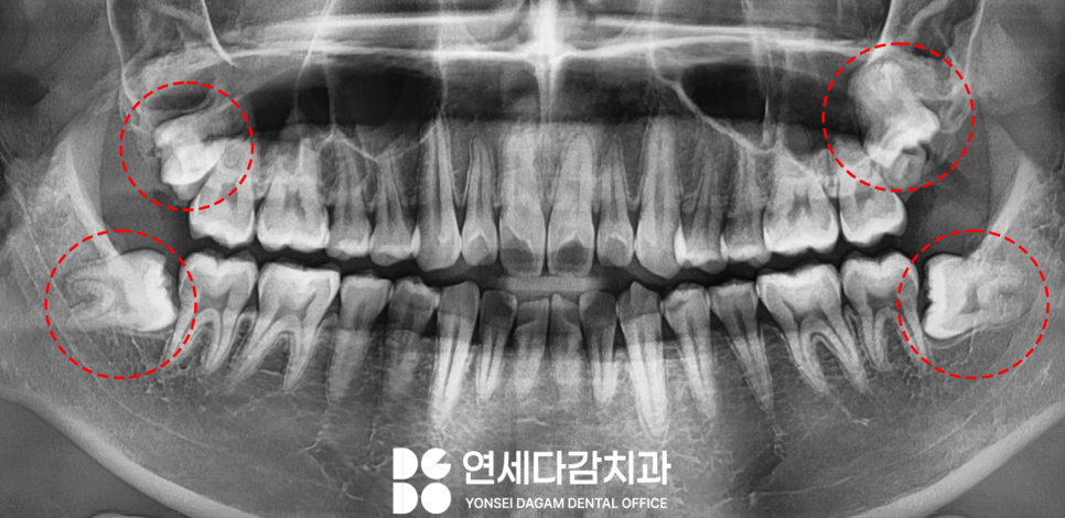 매복 사랑니 옆에 또 다른 치아 이것은 무엇일까요 송파구 가락동 치과 에서 알려드리겠습니다. 관련 이미지 1