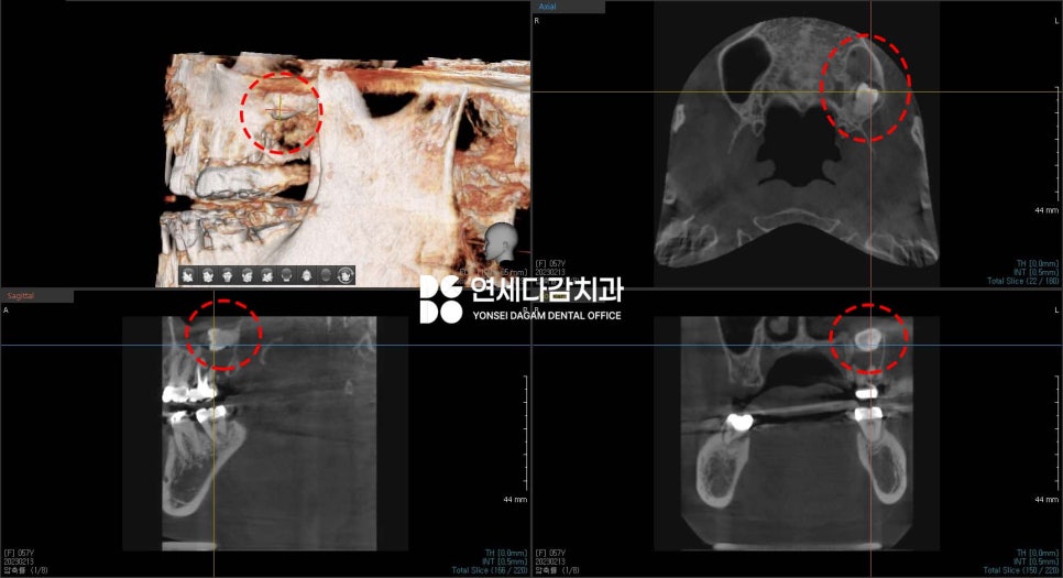 심한 염증으로 특이한 곳에 위치한 매복 사랑니 송파역 치과 에서 임플란트 수술과 함께 안전한 발치 했습니다. (feat. 상악동 천공 폐쇄술 ) 관련 이미지 2