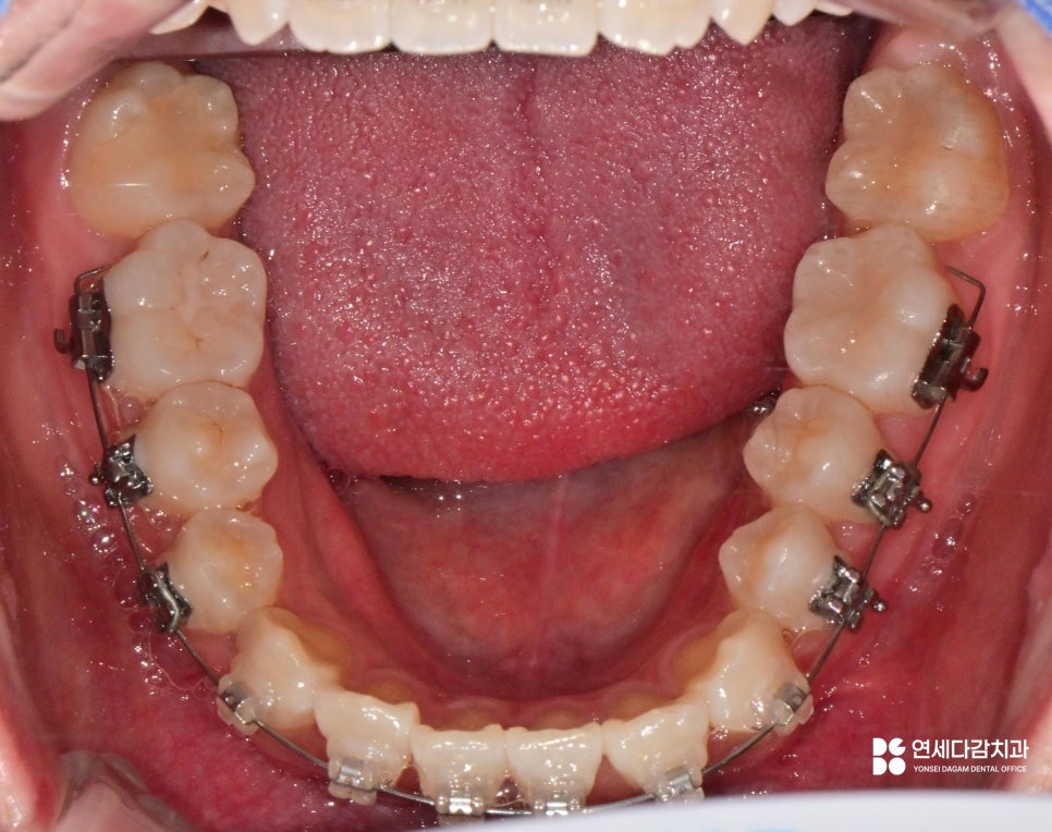 가락동 치과 교정 치료 전 사랑니 발치 꼭 필요할까? - 미성숙 매복케이스로 알아보는 과정 관련 이미지 3