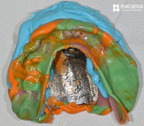 항암 치료 전 발치 필요할 때 기존 부분틀니 송파동 치과 에서 보철 수정 후 임시로 완전틀니 만든 이유 관련 이미지 5