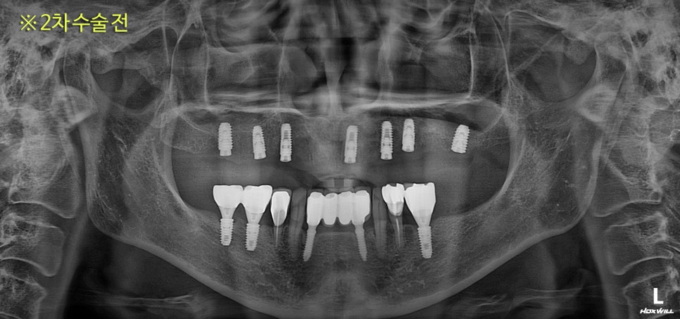 Prosthetics After Implants in Ogeum-dong: Occlusion and Facial Balance Matter Too image 2