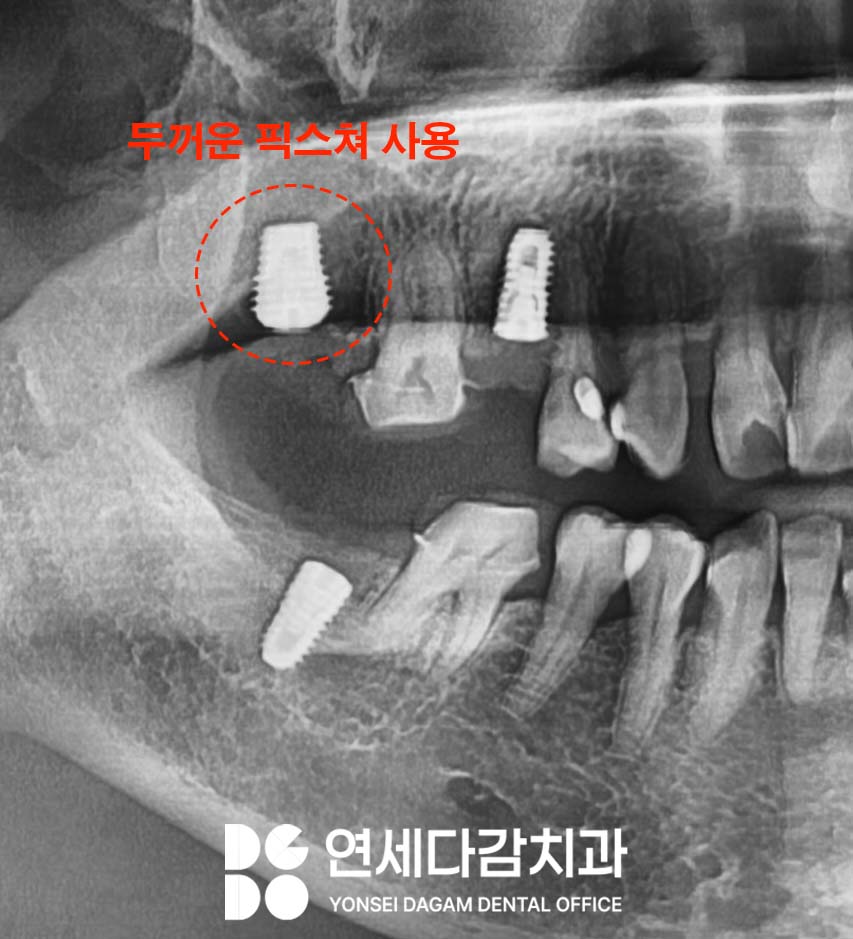 임플란트 재수술 가락동 치과 정밀한 분석과 전략적 접근 통한 치유 과정 관련 이미지 3