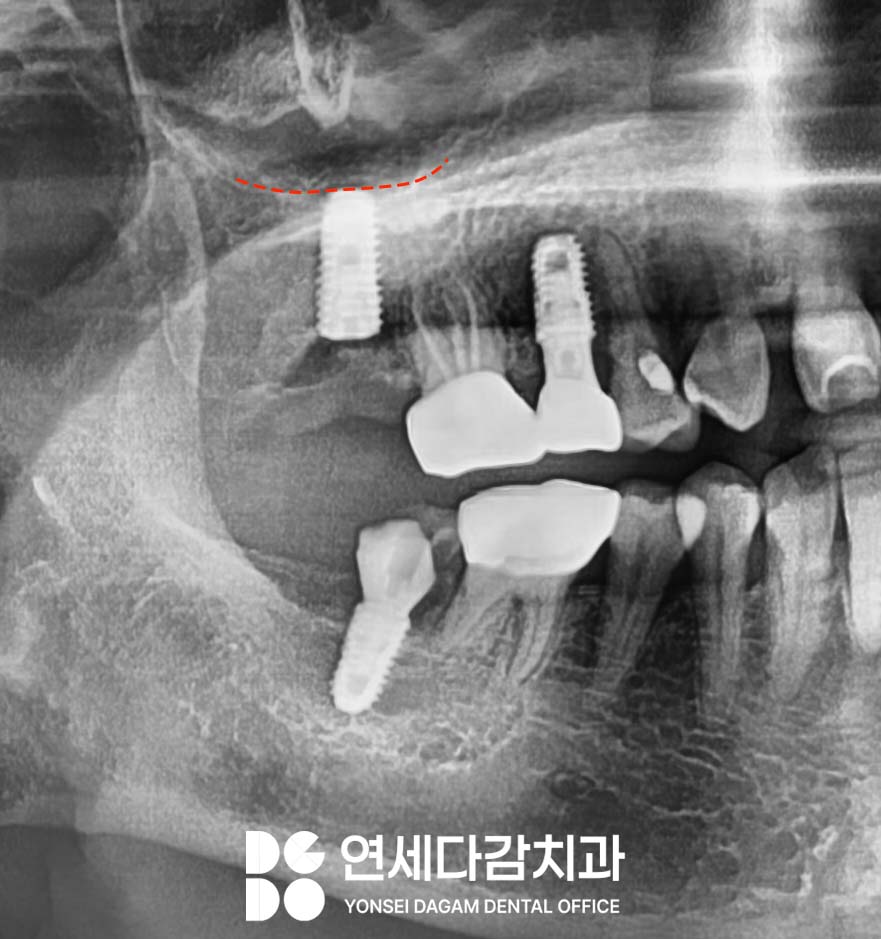 임플란트 재수술 가락동 치과 정밀한 분석과 전략적 접근 통한 치유 과정 관련 이미지 5
