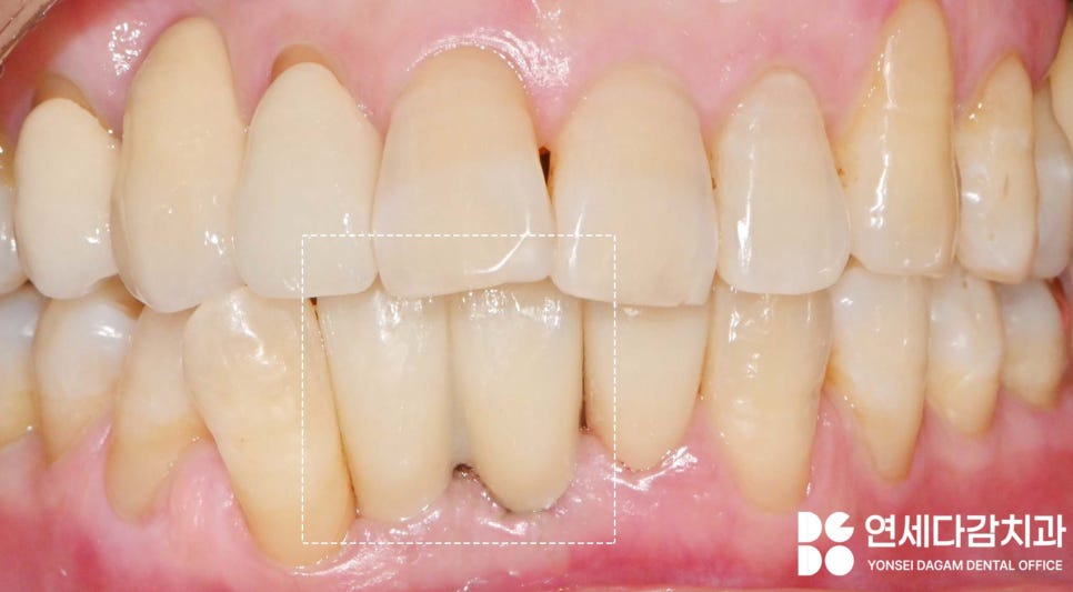 유독 까다로운 수술 부위가 있다? 오금역 치과 브릿지에서 임플란트 전환 과정 관련 이미지 7
