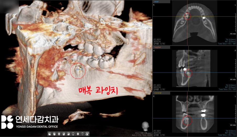 매복과잉치 를 발치할 때 CT 촬영이 필요한 이유? 연세다감치과 의학 정보 전달 글 관련 이미지 4