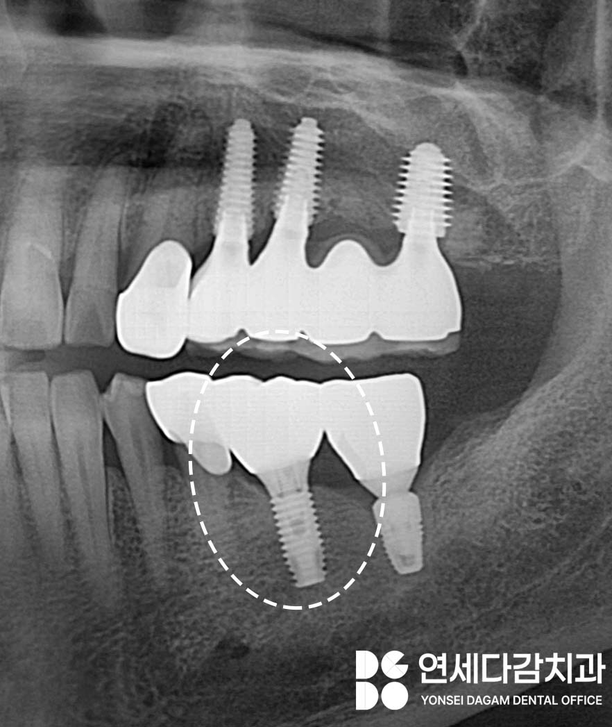 개롱역 치과 오스템 임플란트 종류의 다양성과 형태 구분법, 이것을 이용한 재수술 없는 보철 치료 관련 이미지 7