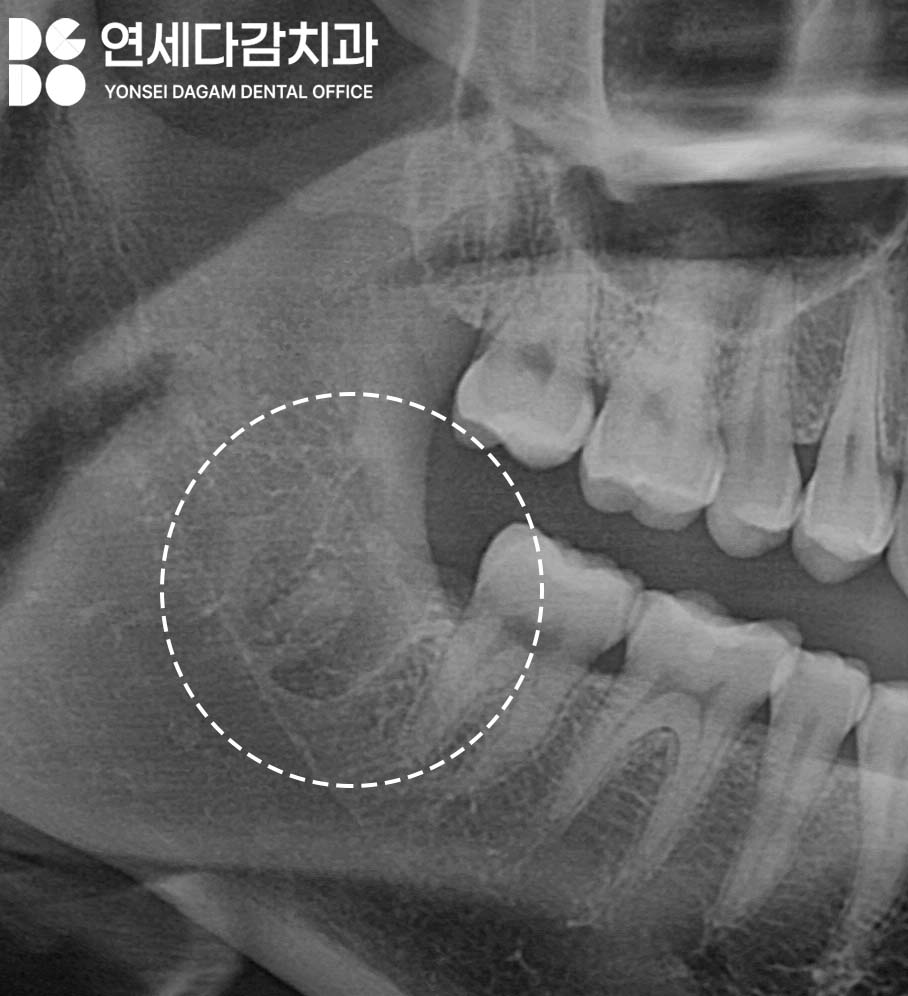 거여동 치과 매복 사랑니 발치 후 치아 뿌리 조각 부러짐 잔존치근 일부러 남겨두는 이유 관련 이미지 9