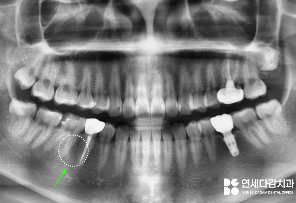 매복과잉치 를 발치할 때 CT 촬영이 필요한 이유? 연세다감치과 의학 정보 전달 글 관련 이미지 7