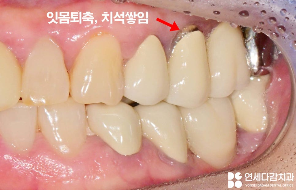 문정역 치과 임플란트 오래 사용하기 위해서 지대주 (어버트먼트) 보철 종류 기성 및 커스텀 지대주 (abutment) 차이 알고 받아야 되는 이유 관련 이미지 2