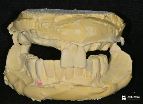 개롱역 치과 치주 질환으로 인한 심한 잇몸뼈 손실 - 네비게이션 방식 임플란트로 진행된 안전한 치료 관련 이미지 4