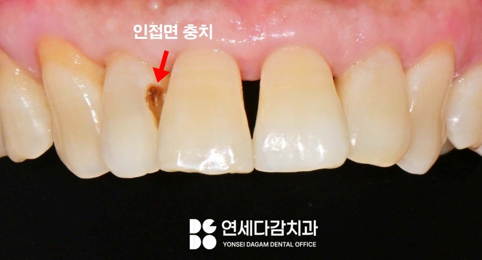 앞니 충치 꼭 크라운 해야 좋을까 송파역 치과 치아 사이 인접면 우식 레진 치료 만으로 충분한 경우 관련 이미지 2