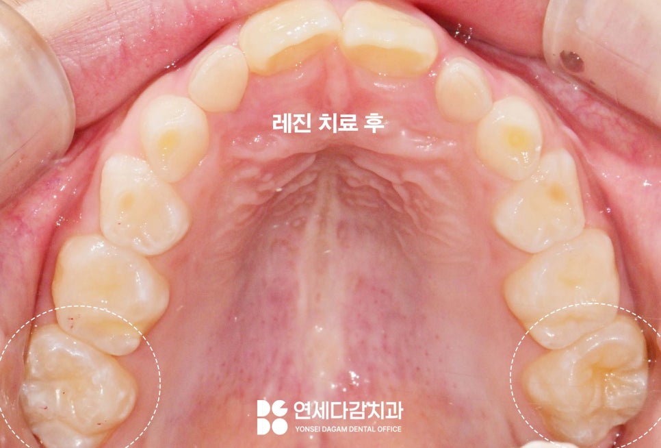 오금동 치과 충치 레진 치료 보험 혜택받을 수 있을까 우리 아이 구강 건강을 위한 치아 우식 예방법 관련 이미지 4