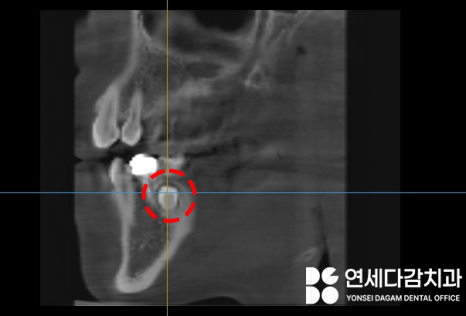 매복과잉치 를 발치할 때 CT 촬영이 필요한 이유? 연세다감치과 의학 정보 전달 글 관련 이미지 6