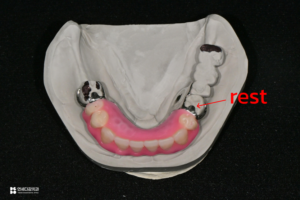오금역 치과 부분틀니, 예후를 고려한 지대치 평가부터 정밀한 설계까지 중요한 이유 관련 이미지 5