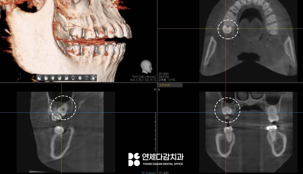 기울어진 매복 사랑니 발치 더 주의깊게 봐야 되는 이유 개롱역 치과 에서 살펴봅시다. 관련 이미지 3