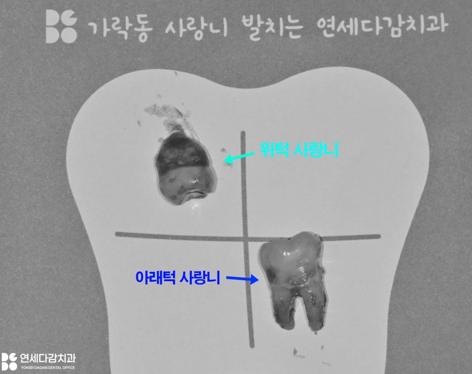 상악동 또는 신경 가까운 누워있는 매복 사랑니 가락시장역 치과 단순 발치를 위한 필수 CT 분석 과정 관련 이미지 6