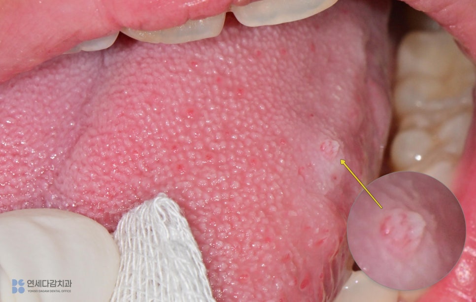 A Bump on the Side of the Tongue: From the Appearance of Oral Papilloma to Treatment | Gaerong Station Dental Clinic image 3