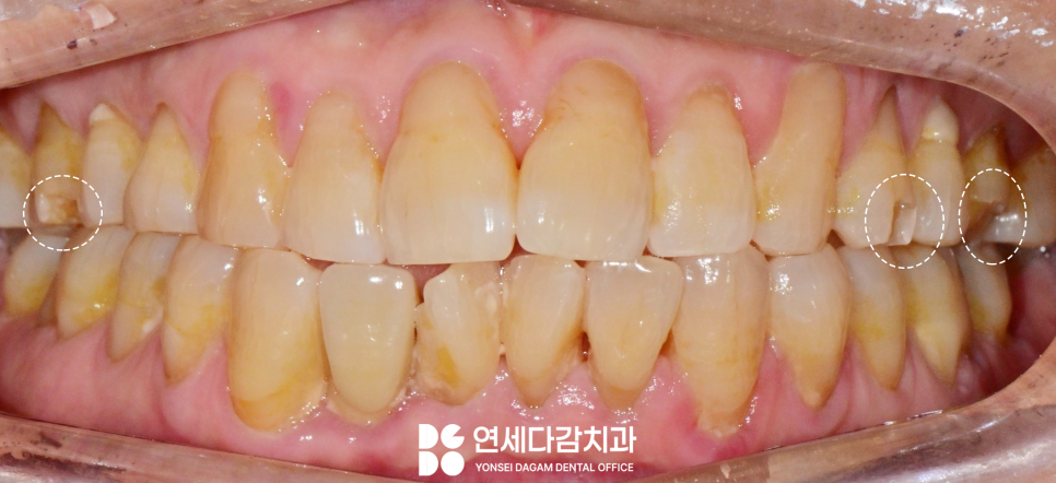 심한 이갈이 원인으로 생기는 치아 마모 및 파절 문제 문정역 치과 교모증 크라운 치료 필요한 이유 관련 이미지 4