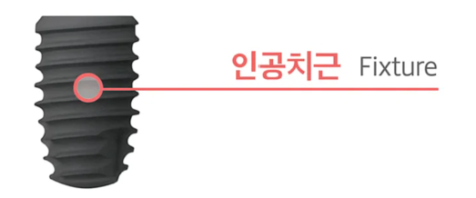 가락동 치과 오스템 임플란트 결과를 좌우하는 핵심 요소 표면처리 기술의 중요성 관련 이미지 1