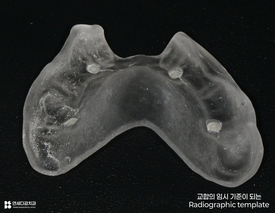 개롱역 치과 치주 질환으로 인한 심한 잇몸뼈 손실 - 네비게이션 방식 임플란트로 진행된 안전한 치료 관련 이미지 6
