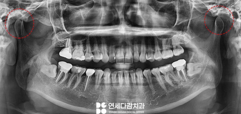턱관절 통증 송파동 치과 에서 원인 찾고 해결 과정 살펴봅시다.(feat. 초음파 물리치료 및 보톡스 ) 관련 이미지 1