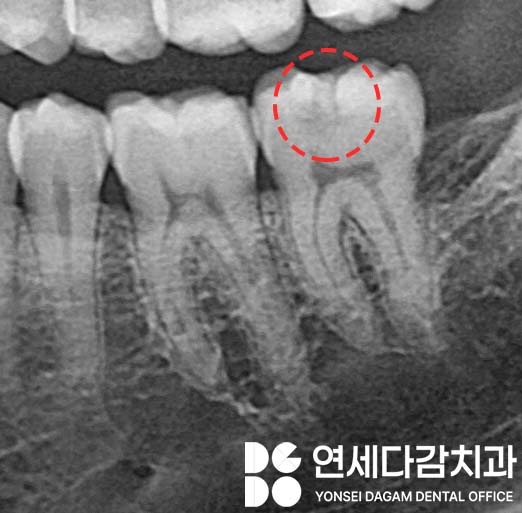 충치 범위에 따른 치료 방법 가락동 치과 레진 또는 인레이 언제 적용할 수 있을까? 관련 이미지 3