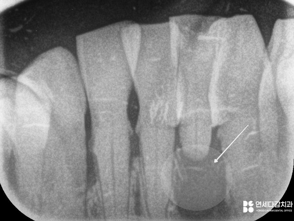 치주염으로 인한 앞니 탈구, 개롱역 치과 에서 설명하는 잠간 고정술 이야기 관련 이미지 5
