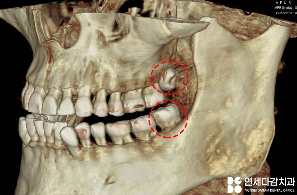 상악동 또는 신경 가까운 누워있는 매복 사랑니 가락시장역 치과 단순 발치를 위한 필수 CT 분석 과정 관련 이미지 2