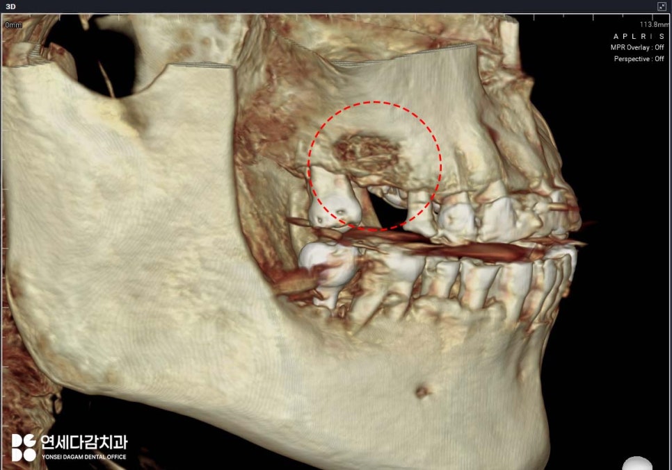 잇몸뼈 없으면 임플란트 수술 못할까? 오금역 연세다감 치과 상악동 거상술 뼈이식 필요한 경우 관련 이미지 3
