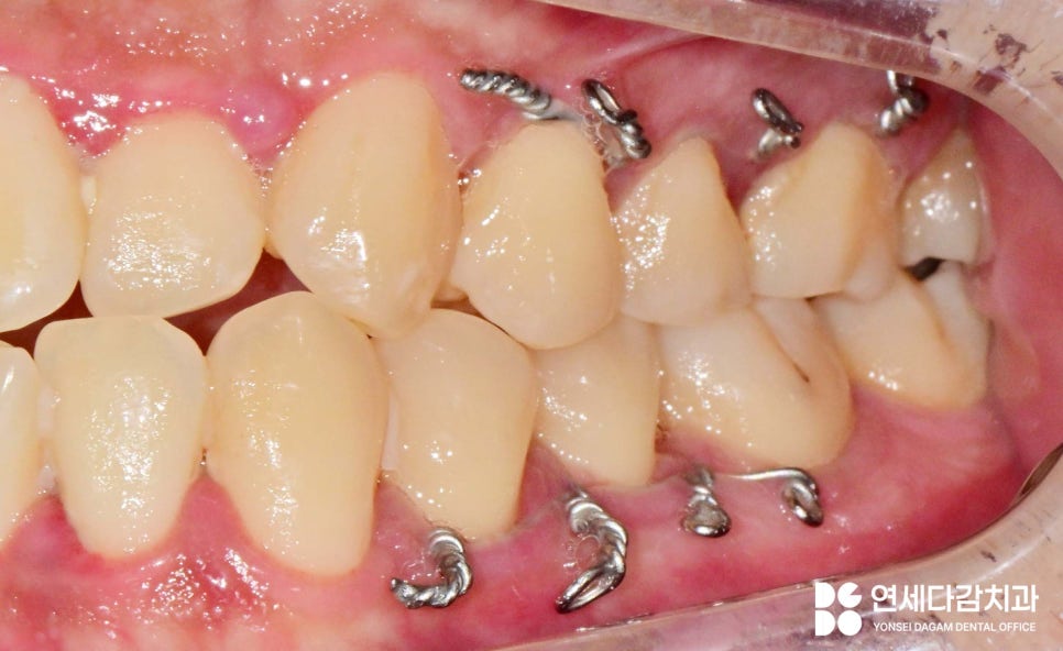 문정역 치과 에서 알아보는 턱뼈 골절 됐을 때 악간고정술 치료 같이 진행하는 이유 관련 이미지 6