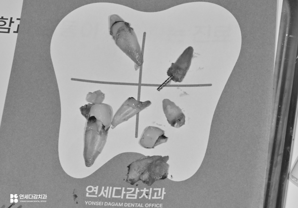 오금역 치과 부분틀니, 예후를 고려한 지대치 평가부터 정밀한 설계까지 중요한 이유 관련 이미지 4