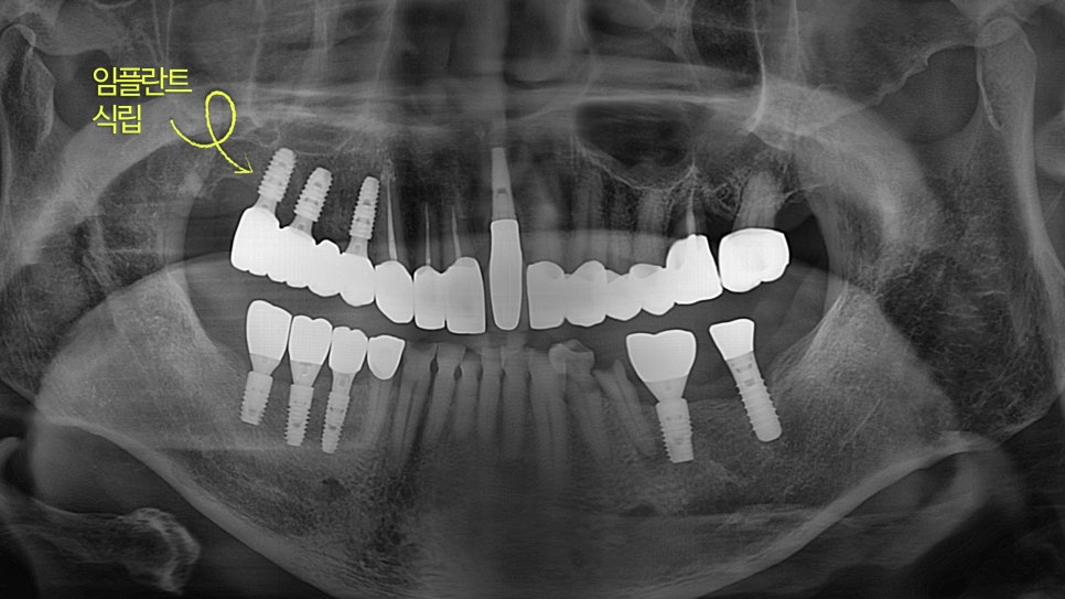 Munjung-dong Dentist: What Does Tooth Attrition Mean, What Are Its Symptoms, and How Is It Treated? image 6