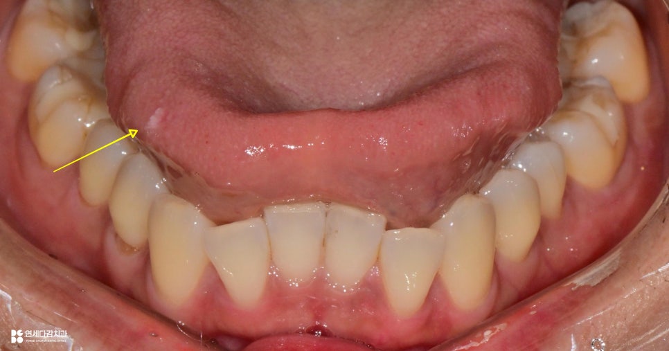 개롱역 치과 혀에 하얀 돌기? 구강 유두종 작아도 조직검사가 필요한 이유 관련 이미지 2