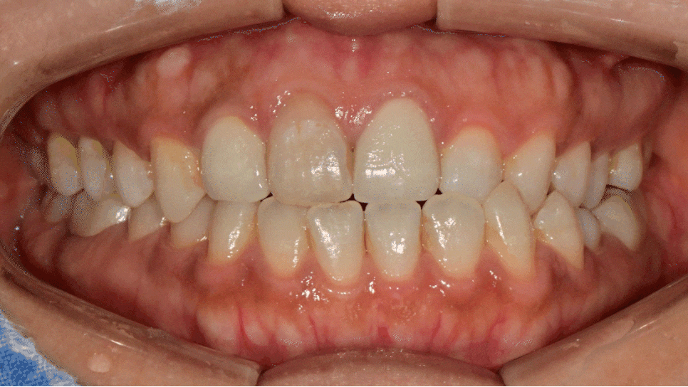 Macheon-dong Dental Clinic: Why Treating Root Inflammation Comes First Before an Anterior Crown image 8