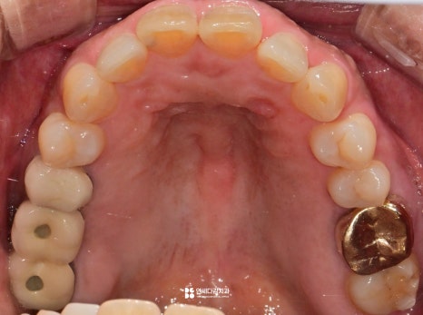 개롱역치과 아프기 전에 발견해야 되는 이유 인접면 충치 치료 관련 이미지 1