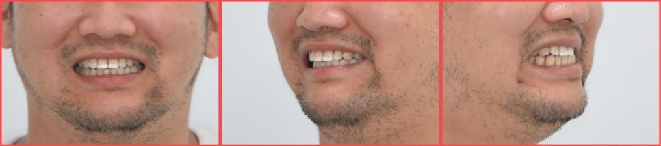 Ogeum-dong Dentist: Want to Improve Front-Tooth Discoloration and Black Triangles at Once with Veneers? <Must-Read> image 3