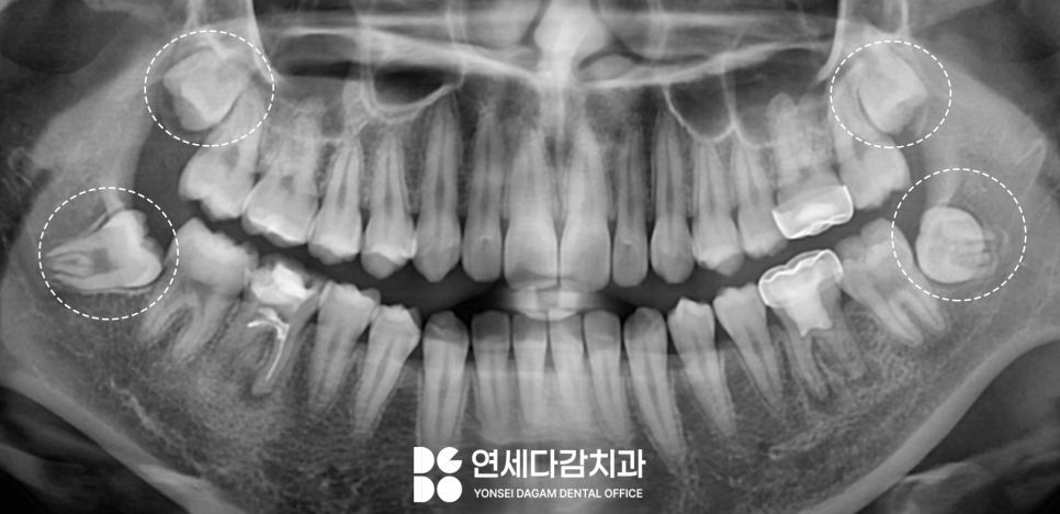 복잡한 매복 사랑니 발치 오금동 치과 에서 CT 촬영을 통한 분석 과정 관련 이미지 1