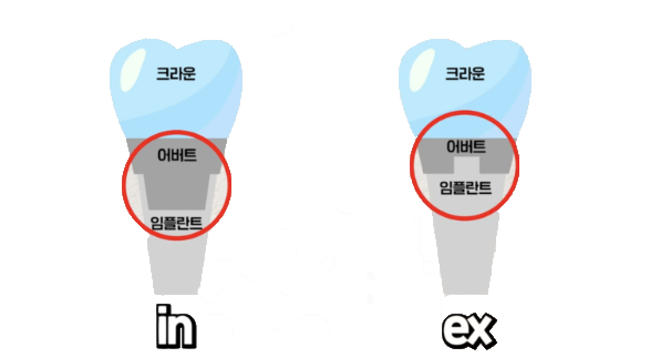 개롱역 치과 오스템 임플란트 종류의 다양성과 형태 구분법, 이것을 이용한 재수술 없는 보철 치료 관련 이미지 4