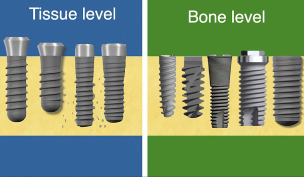 개롱역 치과 오스템 임플란트 종류의 다양성과 형태 구분법, 이것을 이용한 재수술 없는 보철 치료 관련 이미지 3