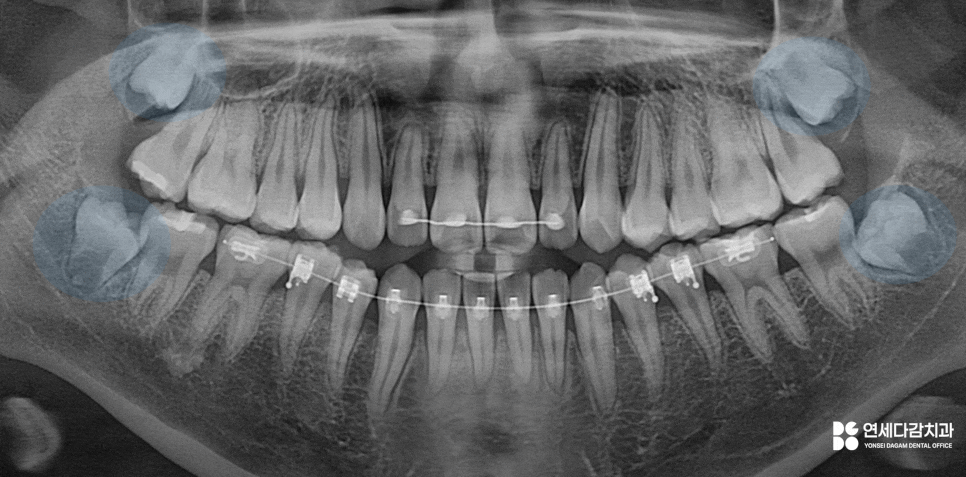 가락동 치과 교정 치료 전 사랑니 발치 꼭 필요할까? - 미성숙 매복케이스로 알아보는 과정 관련 이미지 2