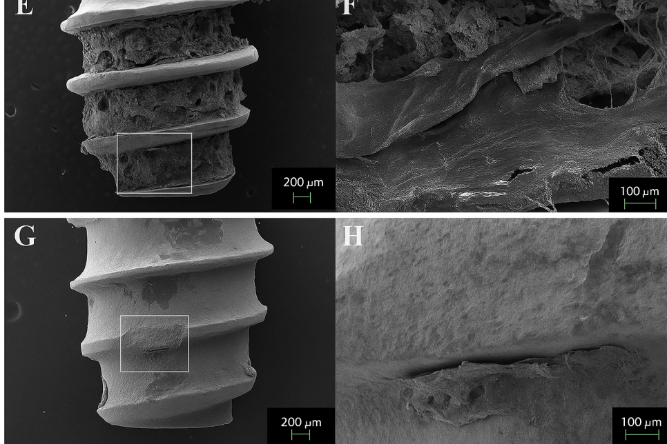 가락동 치과 오스템 임플란트 결과를 좌우하는 핵심 요소 표면처리 기술의 중요성 관련 이미지 6