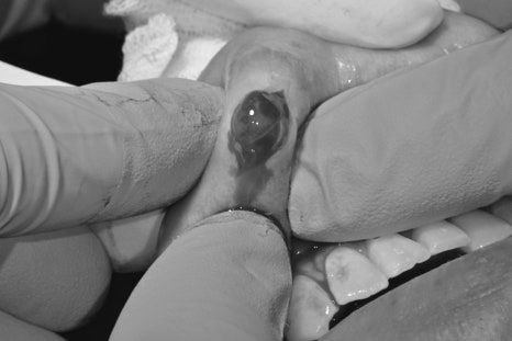 Geoyeo Station Dental Clinic, Mucous Cyst Removal&middot;What If a Lump-Like Bump Protrudes Inside Your Mouth? image 3