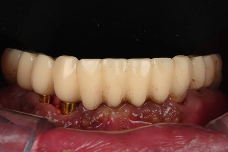 Temporary Teeth After Implants in Songpa-dong: Why They Can Be Provided Quickly image 9