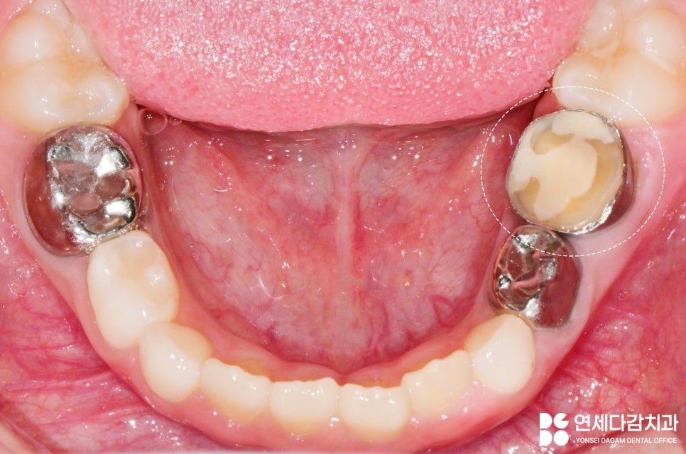 ss크라운 깨졌을 때 다시 제작 가능할까? 송파역 치과 소아 치료 진정요법 없이도 가능했던 이유 관련 이미지 2
