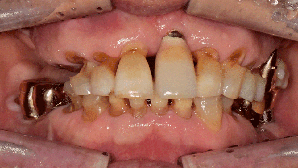 Munjung-dong Dentist: What Does Tooth Attrition Mean, What Are Its Symptoms, and How Is It Treated? image 14