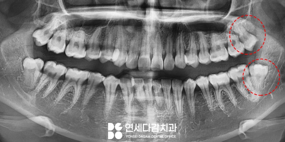 거여역 치과 공포증 수면마취 (의식하진정) 통해 매복 사랑니 발치 및 충치 치료 극복할 수 있습니다. 관련 이미지 1