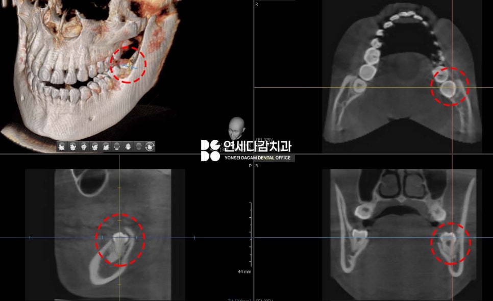 거여역 치과 공포증 수면마취 (의식하진정) 통해 매복 사랑니 발치 및 충치 치료 극복할 수 있습니다. 관련 이미지 4